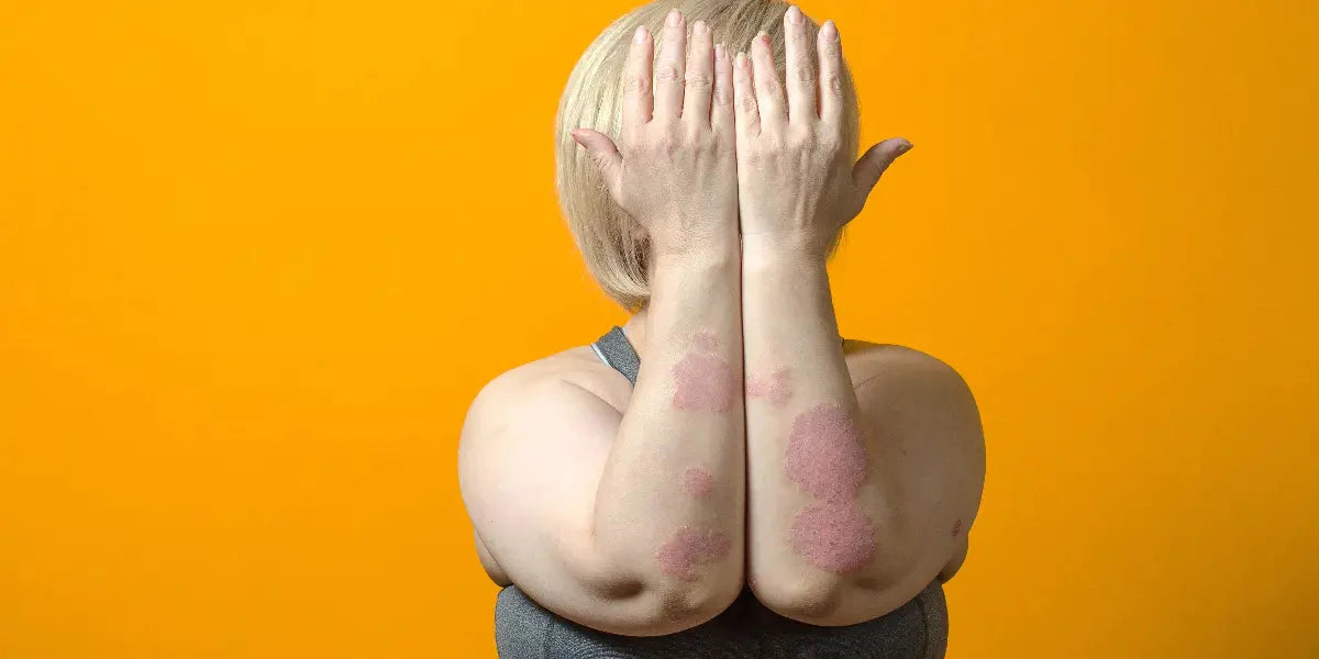 Un guide complet pour comprendre le traitement naturel du psoriasis