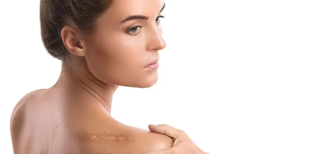 Les différentes techniques de gestion des cicatrices