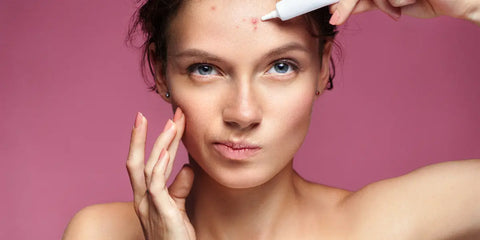 Comment traiter naturellement l'acné