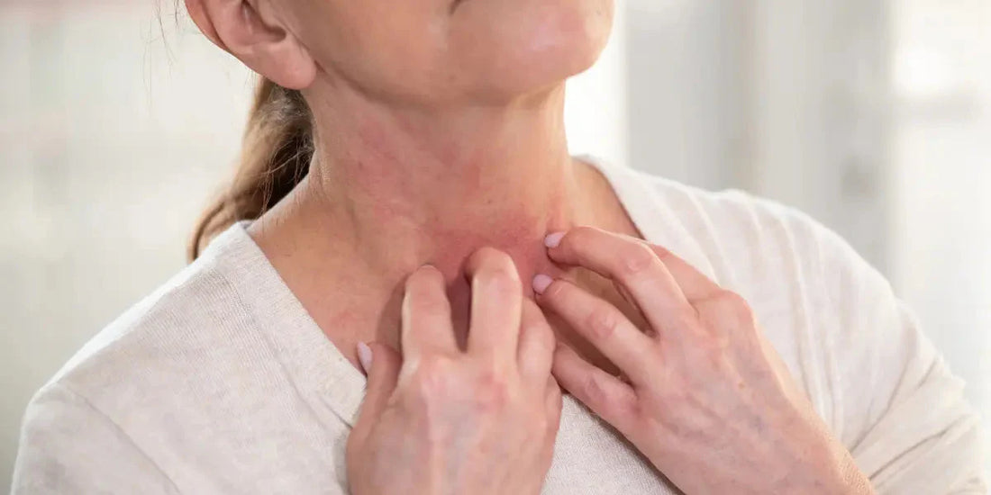 Mieux Comprendre l’Eczéma