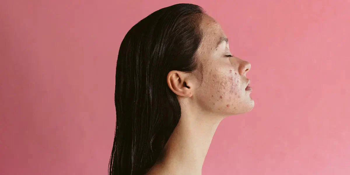 Acné hormonale : causes, remèdes naturels et prévention